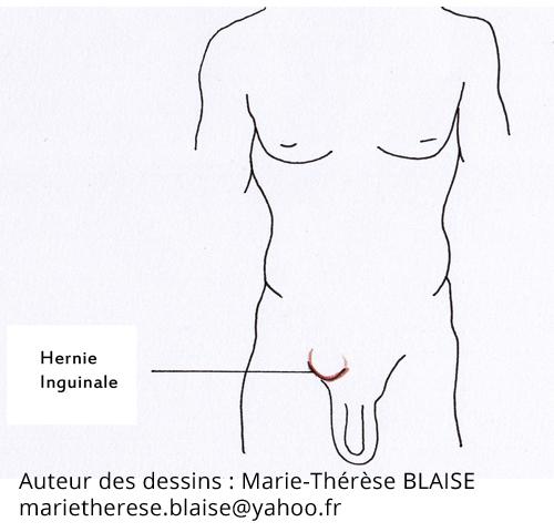 la hernie INGUINALE …