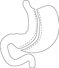 La gastrectomie longitudinale ou « Sleeve Gastrectomy »