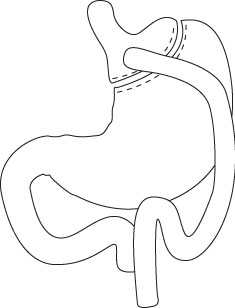 Le by-pass gastrique en Y