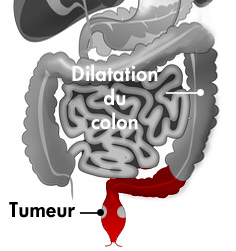 cancer rectum