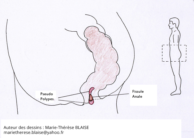 fissure anale