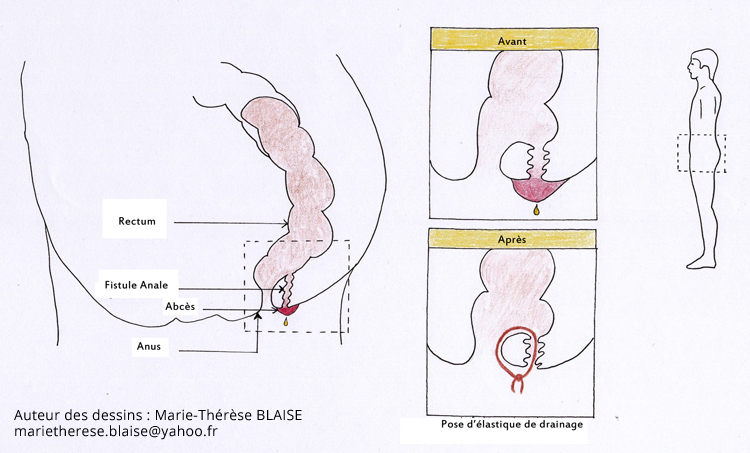 fistule anale