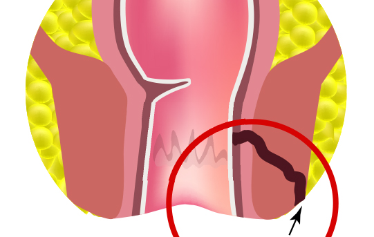 Fistule anale