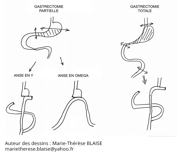 gastrectomie