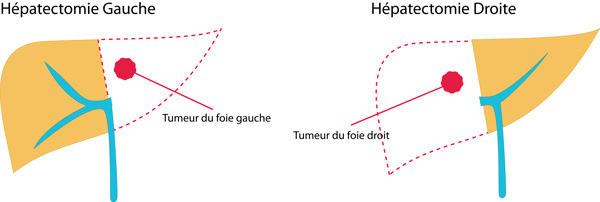 hépatectomie droite et l’hépatectomie gauche,