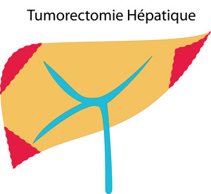 tumorectomie