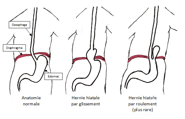 Hernie hiatale