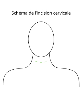 incision cervicale