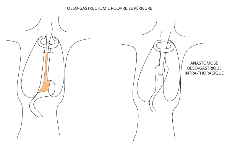 oeso gastrectomie polaire