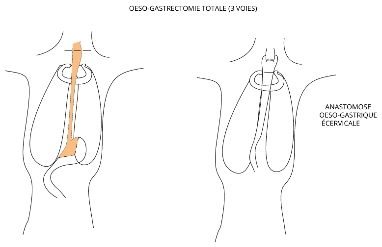 oeso-gastrectomie