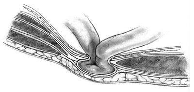 paroi-abdominale