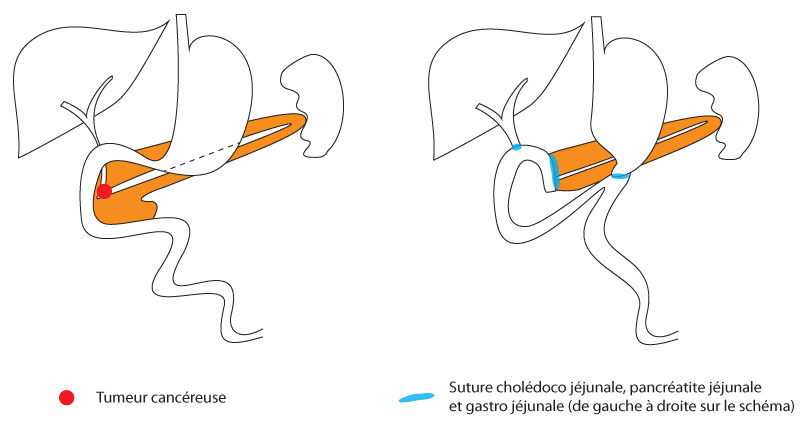 Duodéno pancréatectomie