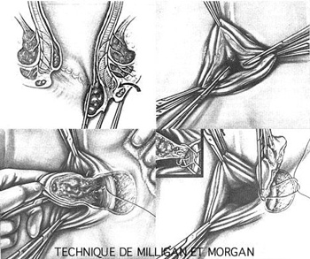 technique Miligan et Morgan