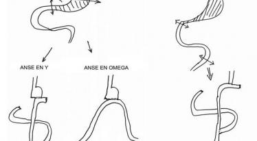 Tumeur estomac, cancer