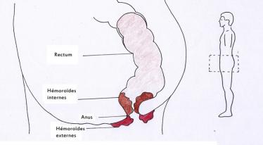 Pathologies hémorroïdaires