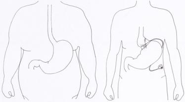 Anneau gastrique ajustable